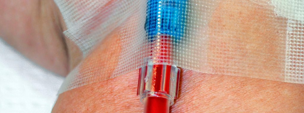 Um cateter vermelho é fixado na pele com curativo transparente. Atualizações sobre as Recomendações de Prevenção de Infecção Primária de Corrente Sanguínea.