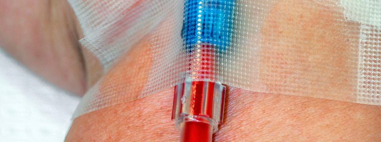 Um cateter vermelho é fixado na pele com curativo transparente. Atualizações sobre as Recomendações de Prevenção de Infecção Primária de Corrente Sanguínea.